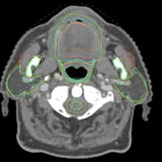 CT Neck with Oral Cavity